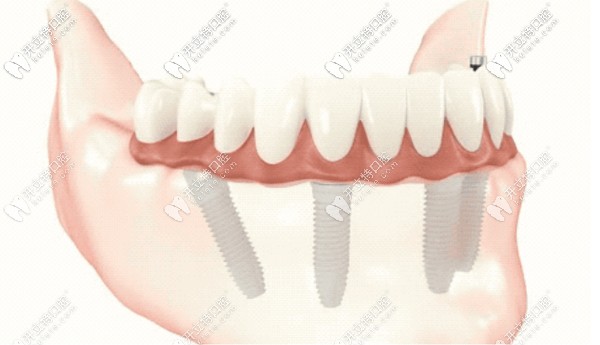 重慶牙博士口腔4-6顆植體恢復(fù)半口牙