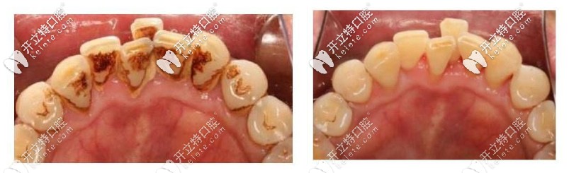 洗牙前后對(duì)比照