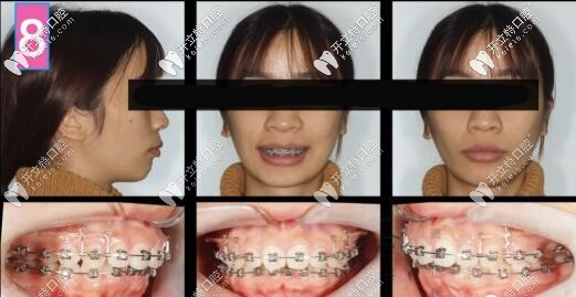 凸嘴支抗釘內(nèi)收