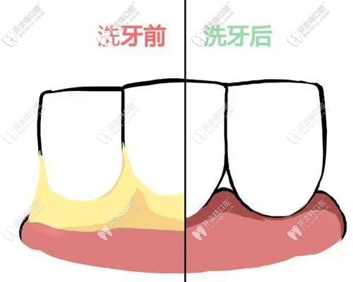 洗牙后牙縫會(huì)變大