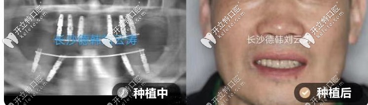 劉云濤：上半口all-on-6種植、下半口all-on-4種植