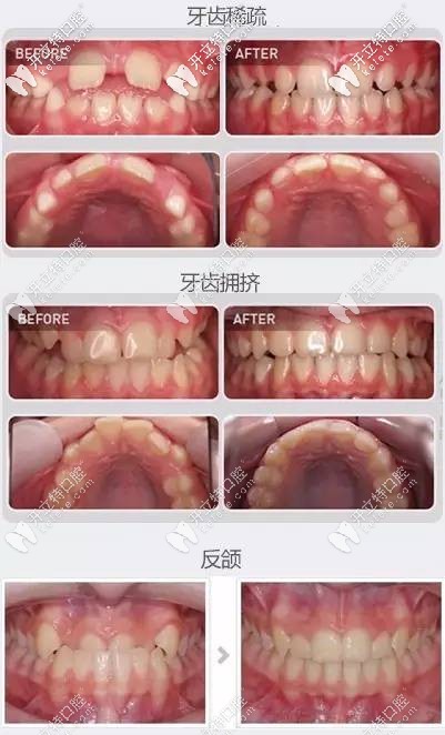 熊醫(yī)生-兒童早期牙齒矯正案例（牙齒不齊、反頜等癥狀）