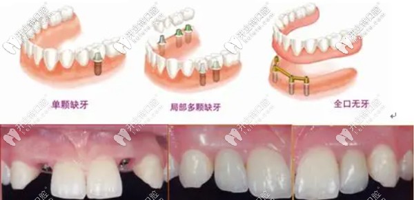 重慶牙博士當(dāng)天種牙、當(dāng)天戴牙當(dāng)天用
