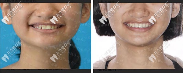 長沙牙祖口腔沙米矯正案例二
