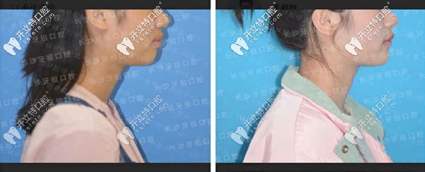 長沙牙祖口腔沙米矯正案例一