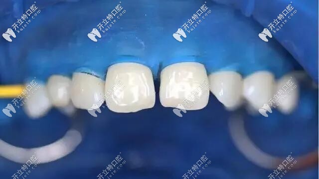 牙科為什么要用橡皮障?橡皮障隔濕的優(yōu)點和收費都在這兒