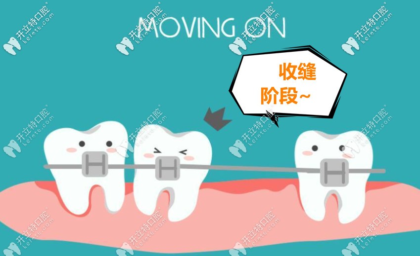 拔牙后矯正牙齒收縫怎么收回去的
