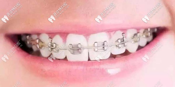 自鎖矯正器 自鎖矯正器