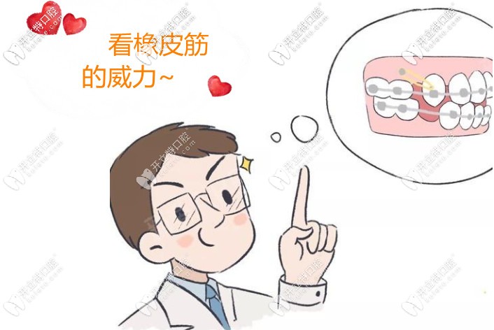 利用橡皮筋達到牙齒移動的目的