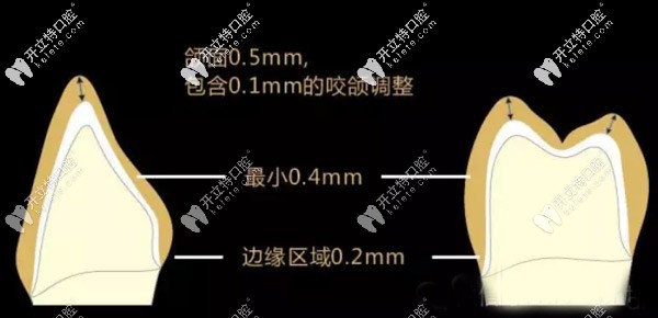 德國進(jìn)口材料的格萊美全瓷牙價(jià)格