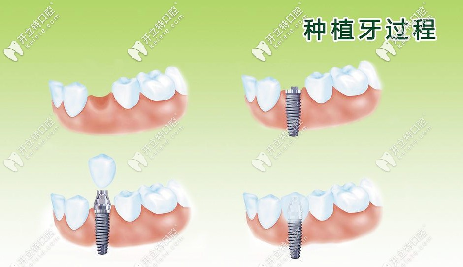 種植牙過(guò)程