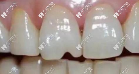 常吃堅(jiān)果會加速牙齒的磨耗，使牙齒出現(xiàn)裂紋