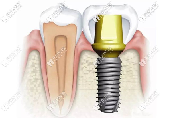 廣州天河區(qū)牙科做種植牙的費(fèi)用 廣州天河區(qū)牙科做種植牙的費(fèi)用