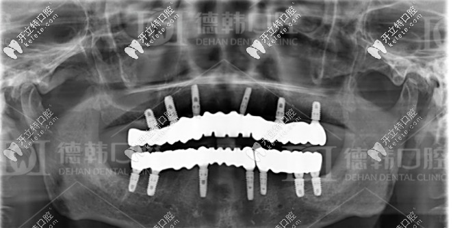 種牙成功后的牙片 種牙成功后的牙片