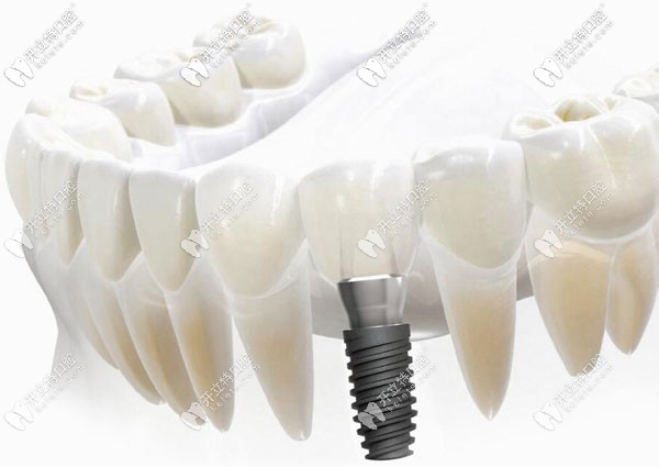 天河區(qū)做歐美種植牙的價(jià)格 天河區(qū)做歐美種植牙的價(jià)格