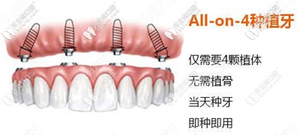 滿口allon4/6即刻負重技術