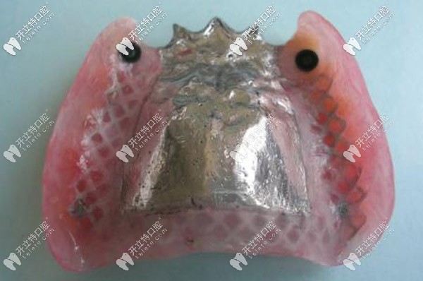 全口半固定種植技術