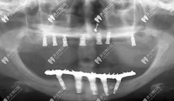 滿口傳統(tǒng)種植技術