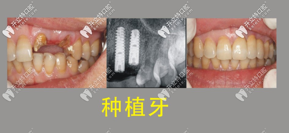 種植牙前后對比