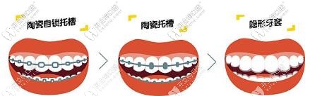 牙齒矯正牙套種類