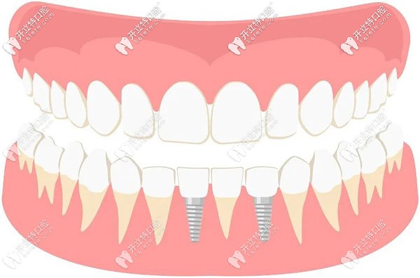 種植牙咀嚼功能恢復(fù)百分之多少