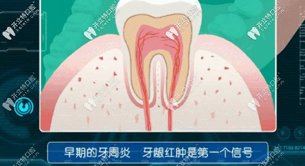 早期牙周炎，牙齦紅腫是個信號