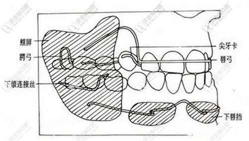 戴入附平面導(dǎo)板的上頜活動矯治器