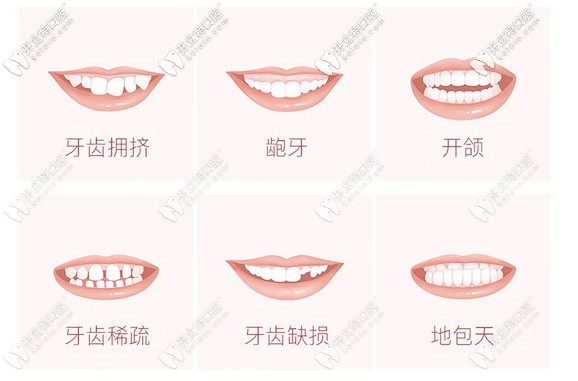 牙齒矯正的適應(yīng)癥狀