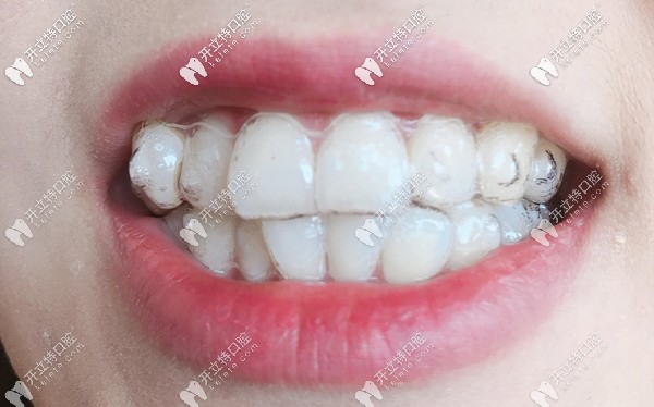 在廣州做國產(chǎn)或進口隱形矯正的費用