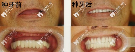 半口種植牙的前后對比 半口種植牙的前后對比
