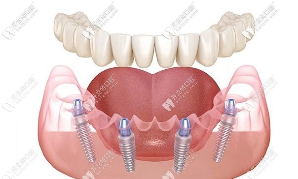 all-on-4種植技術 all-on-4種植技術