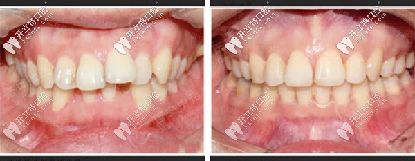 齙牙陶瓷自鎖矯正前后對比