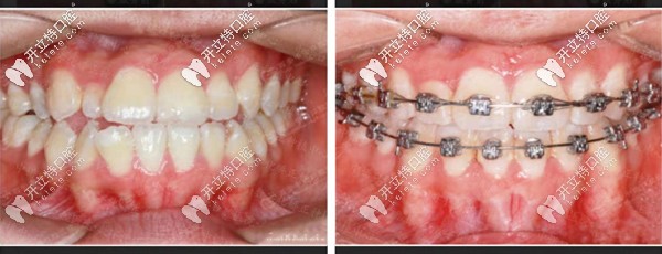地包天金屬自鎖矯正前后對比