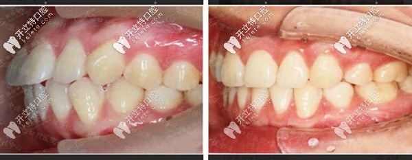 牙齒前凸時(shí)代天使隱形矯正前后對比