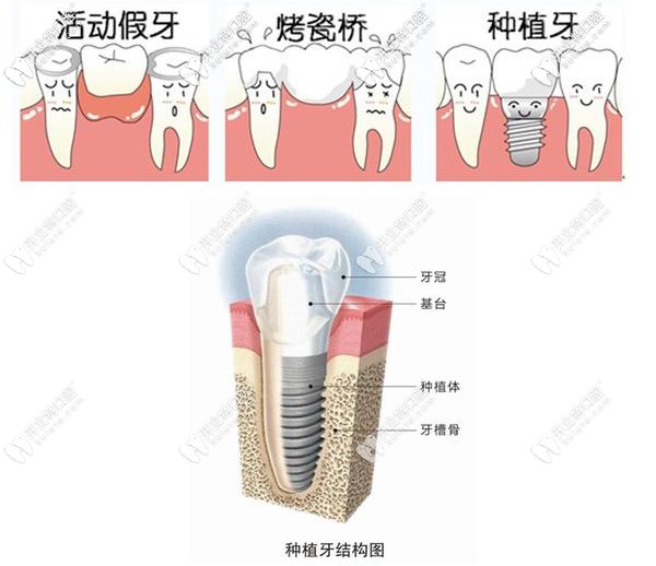種植牙與活動(dòng)假牙區(qū)別圖