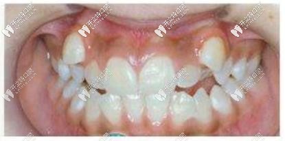 矯正前的牙齒 矯正前的牙齒