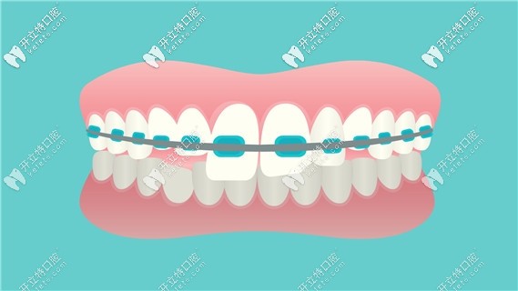 晉城牙齒矯正的費(fèi)用參考