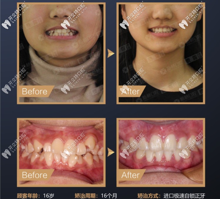 費(fèi)露醫(yī)生的正畸案例