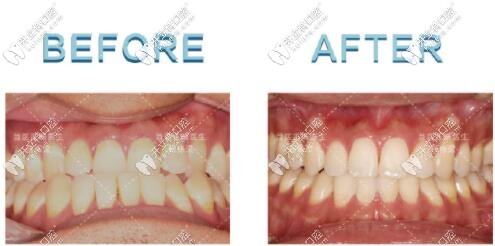 骨性地包天矯正后牙齒的變化