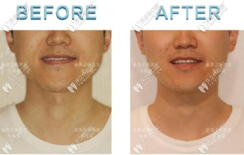 成人骨性地包天矯正后正臉變化對(duì)比