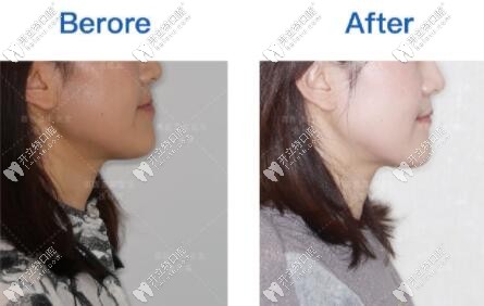 小姐姐矯正地包天后側(cè)臉的對(duì)比圖