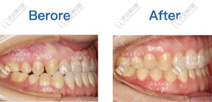 牙齒基本上也解除了反頜
