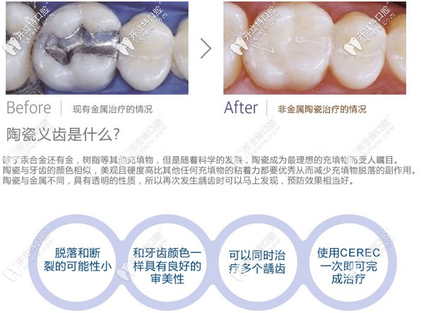 補牙采用非金屬治療