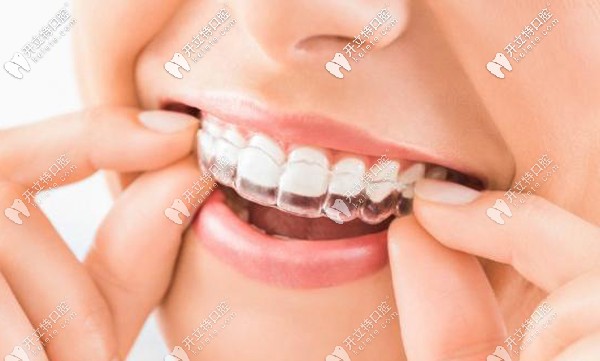 求鄭州口腔矯正牙齒的費用，隱適美箍牙價格一般多少錢