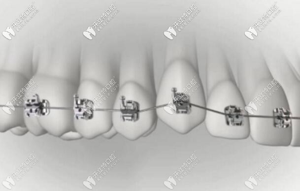 牙齒矯正順序中是先排齊還是先收縫?如果拔牙四顆要收多久