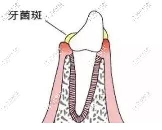 牙菌斑圖片