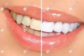 牙齒美白