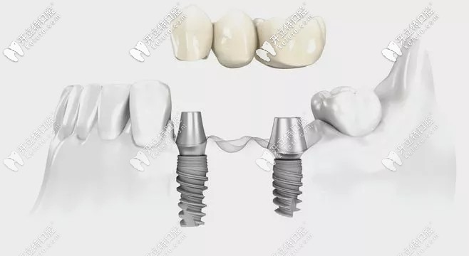 種植牙結構示意圖