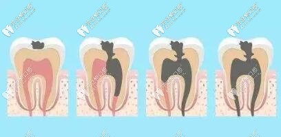 齲齒發(fā)展過(guò)程