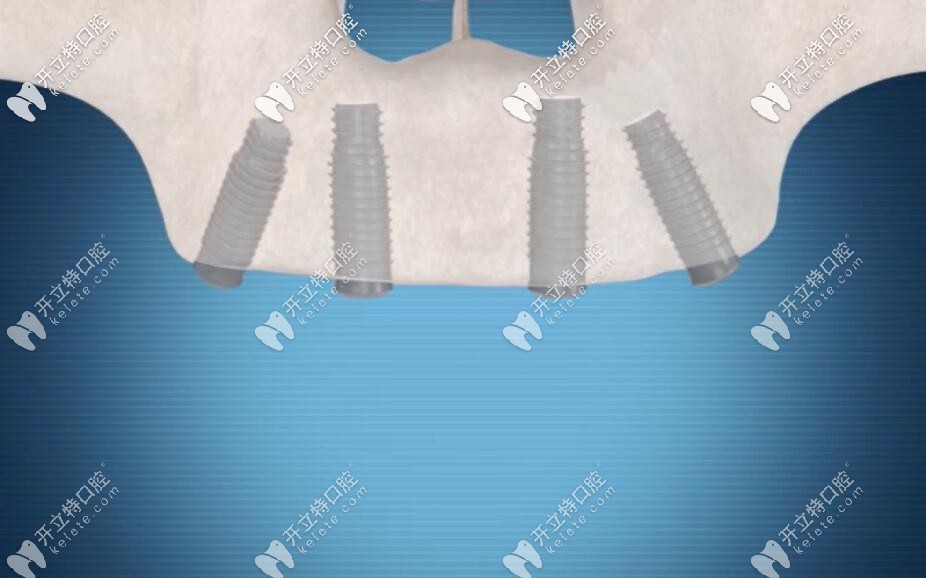 接著再種2顆斜植體